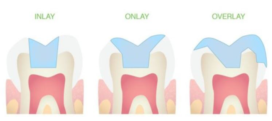 Inlays ou onlays - Dentiste Aix Les Bains - Dr BARBONI